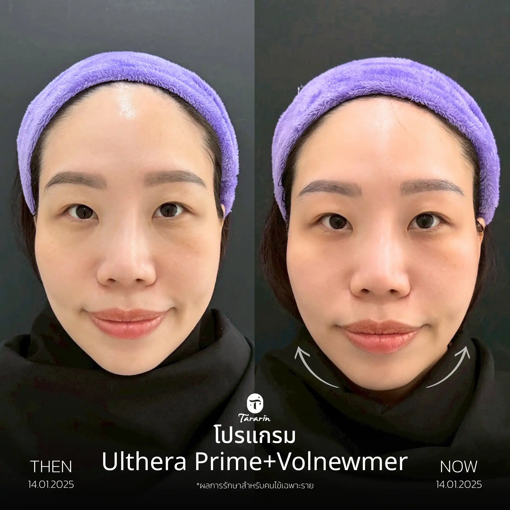 รีวิวยกกระชับ Ulthera Prime + Volnewmer — ธารารินคลินิก