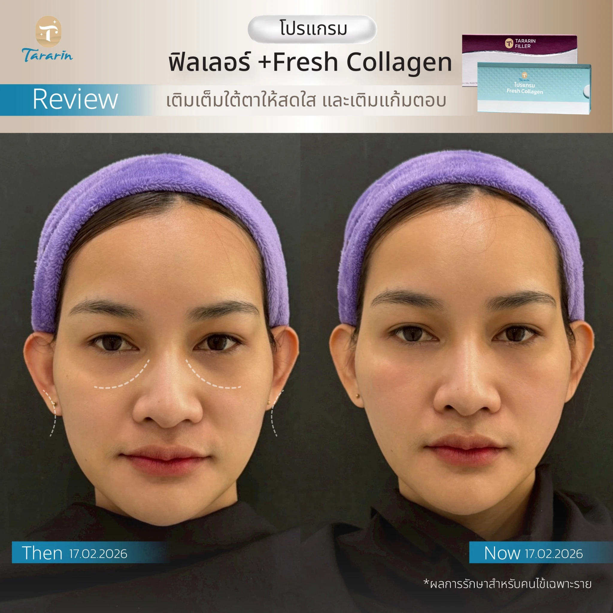 รีวิวโปรแกรมฉีดฟิลเลอร์ใต้ตา พร้อมเติม Fresh Collagen