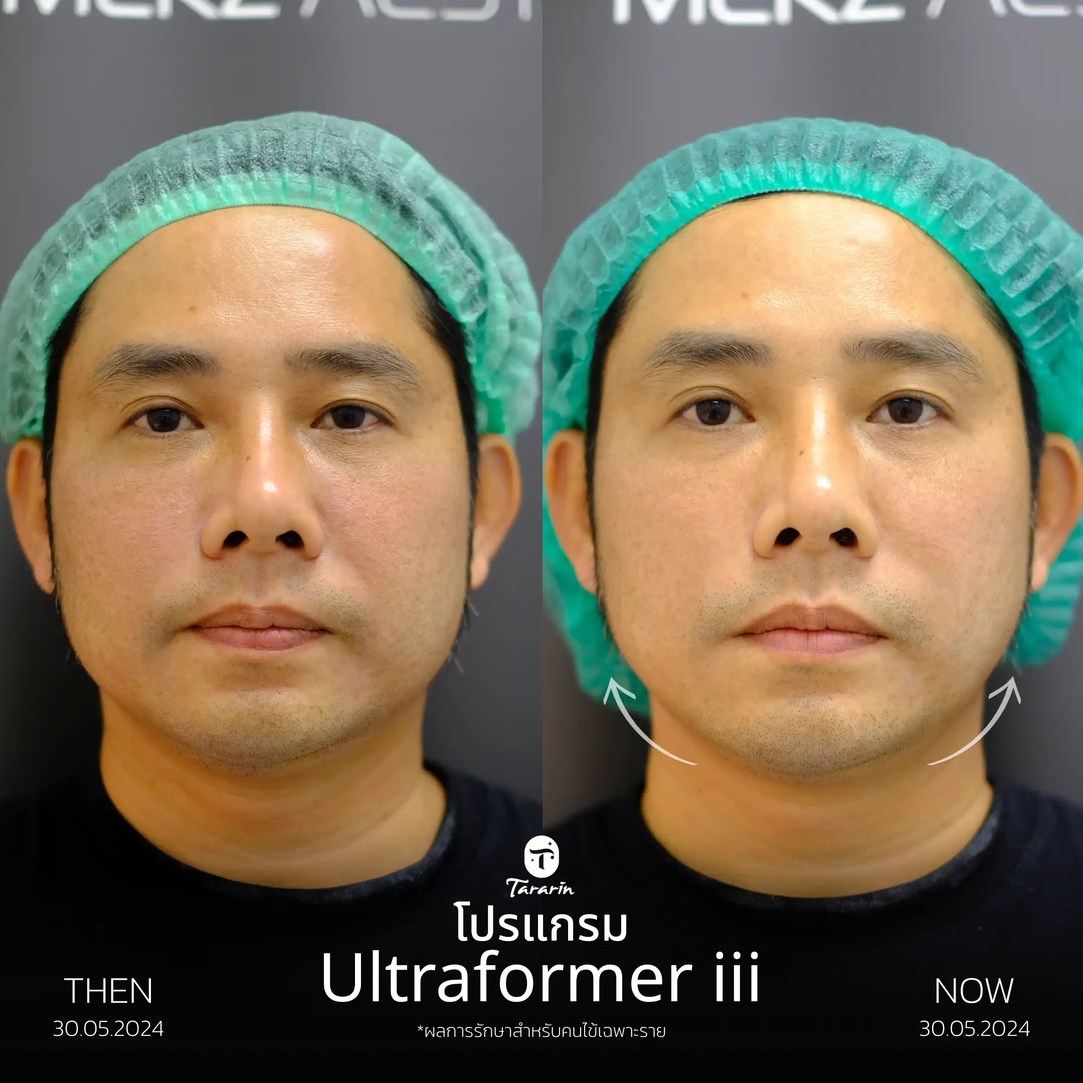 รีวิวยกกระชับ Ultraformer III ผู้ชาย — ธารารินคลินิก