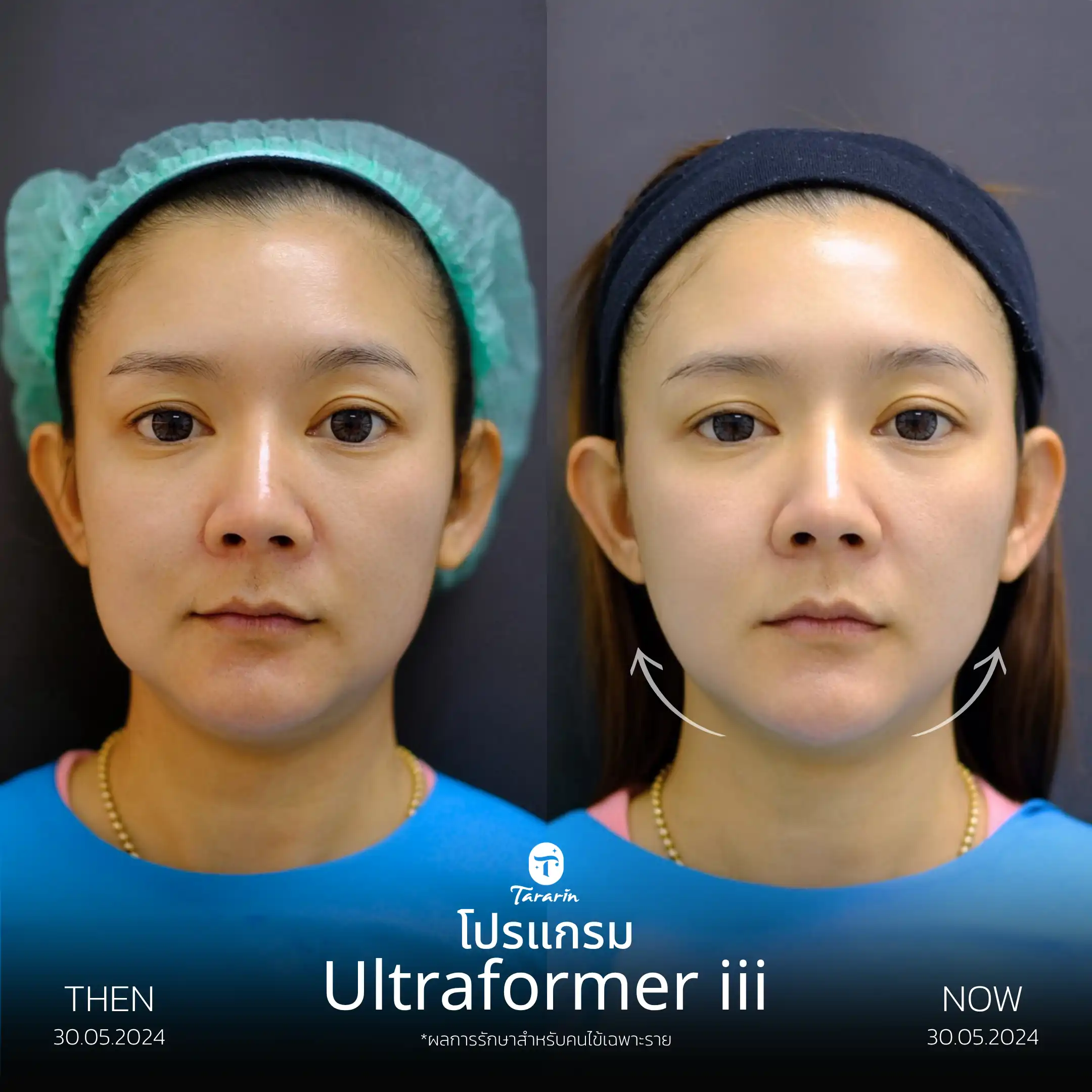รีวิวยกกระชับ Ultraformer III — ธารารินคลินิก