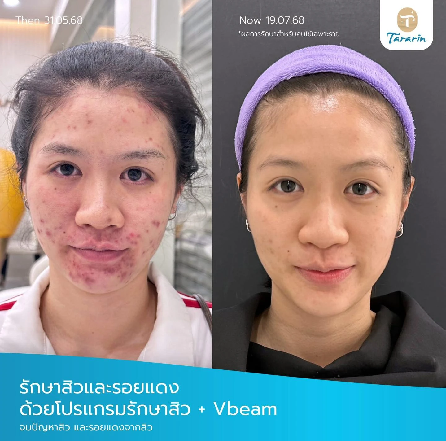 รีวิวโปรแกรมรักษาสิวและรอยแดงสิว