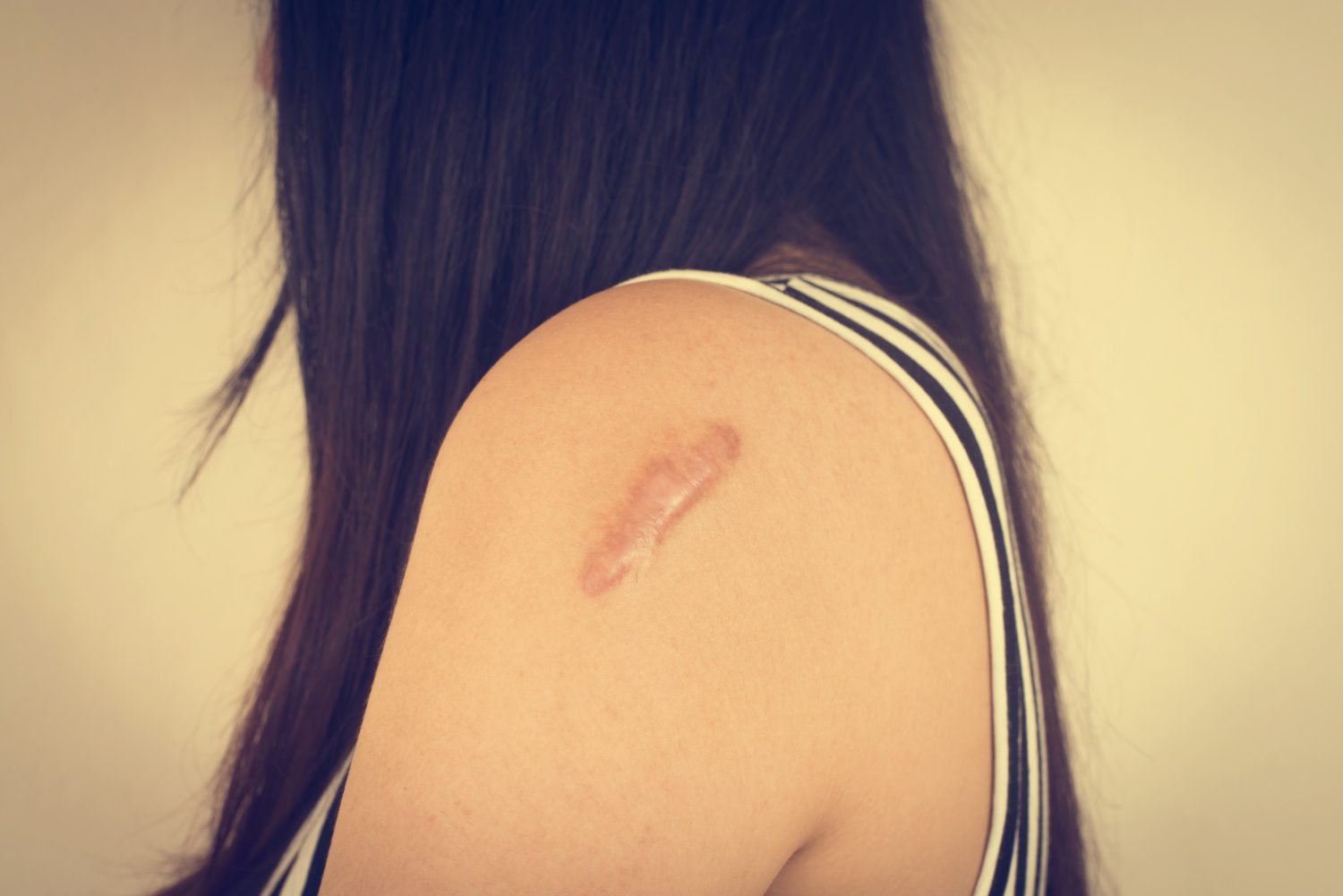 SCAR REMOVAL (เลเซอร์ลบรอยแผลเป็น)