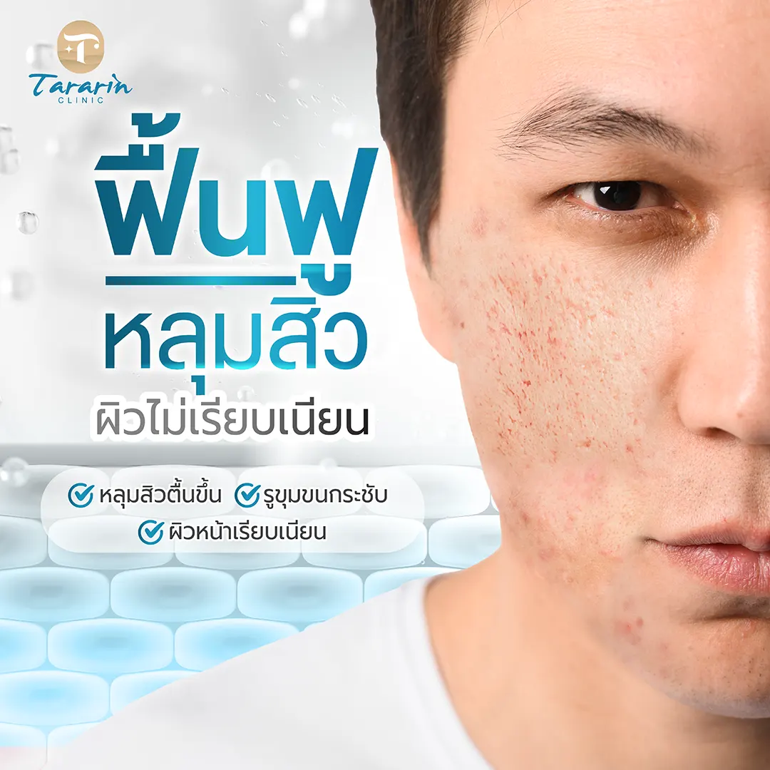 เลเซอร์หลุมสิว รูขุมขนกว้าง รอยแตกลาย