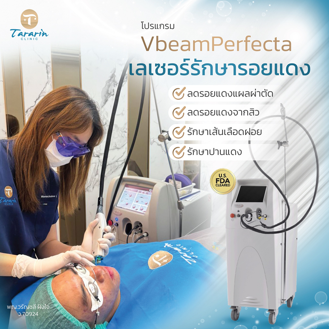 VBeam Perfecta : ทางเลือกในการรักษารอยแดงบนใบหน้า