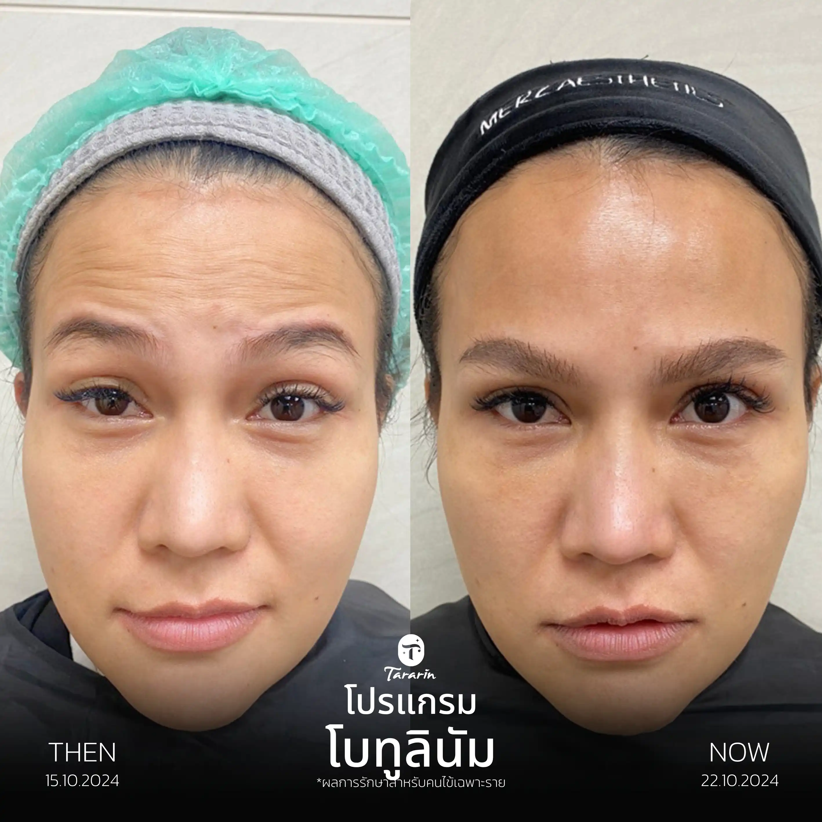 รีวิวโปรแกรมโบทูลินัม ลดริ้วรอย — ธารารินคลินิก