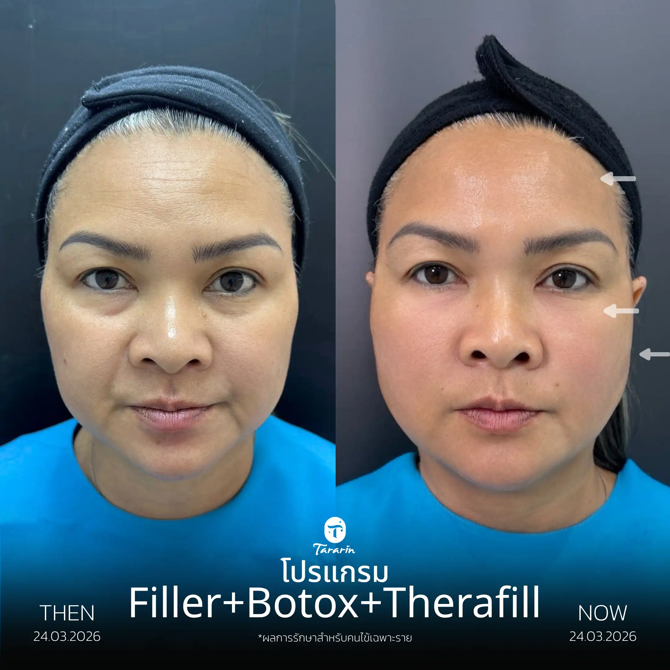 รีวิวโปรแกรมฟิลเลอร์แก้ม โบทูลินัมริ้วรอย ดูแลใต้ตา — ธารารินคลินิก