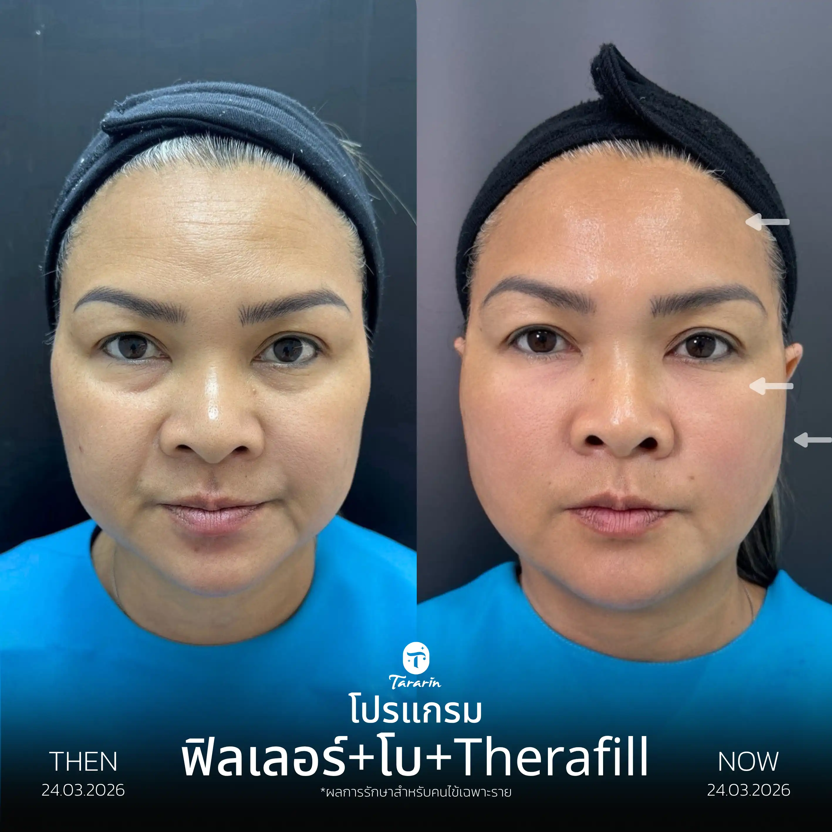 รีวิวโปรแกรมฟิลเลอร์แก้ม โบทูลินัมริ้วรอย ดูแลใต้ตา — ธารารินคลินิก