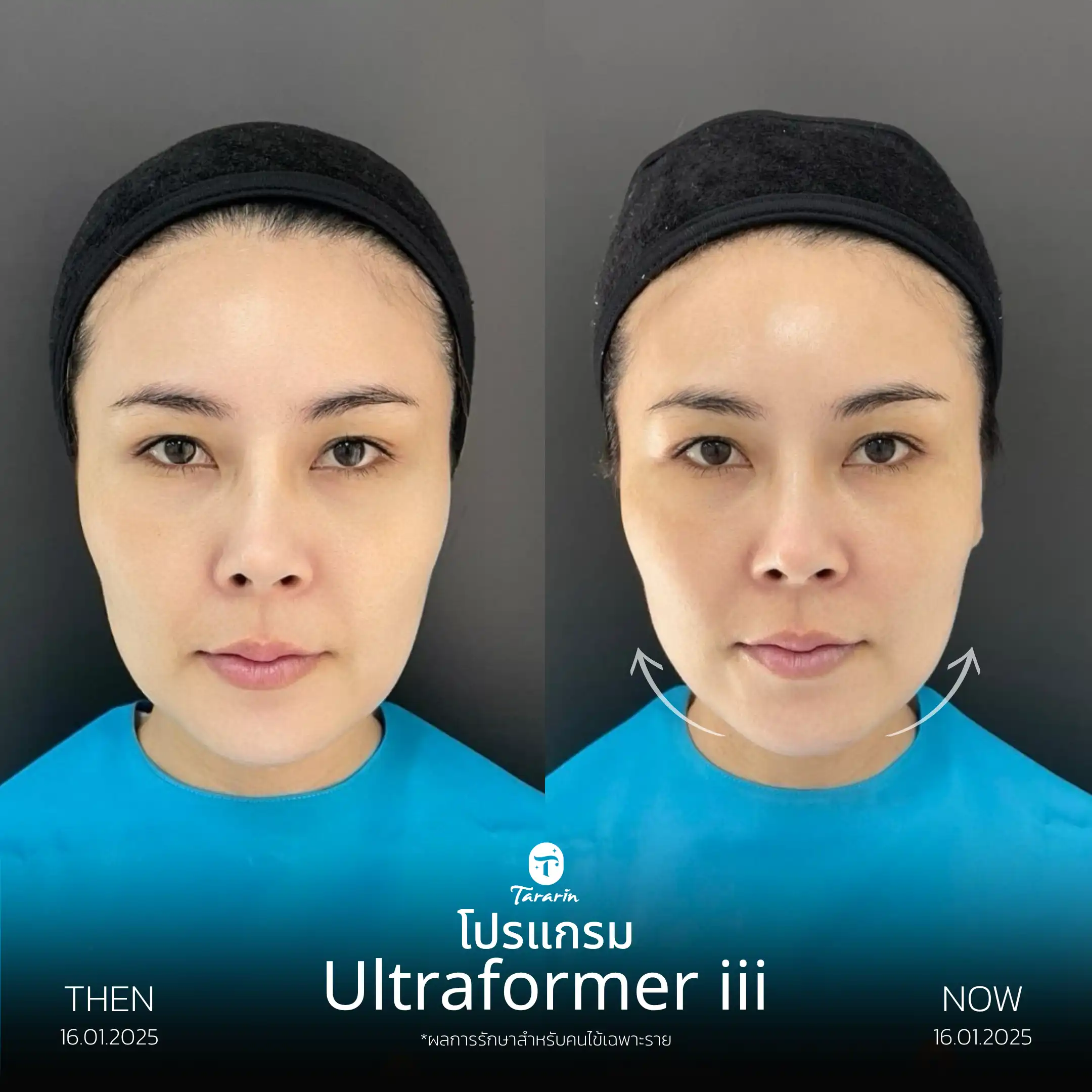 รีวิวโปรแกรมยกกระชับด้วย Ultraformer III — ธารารินคลินิก