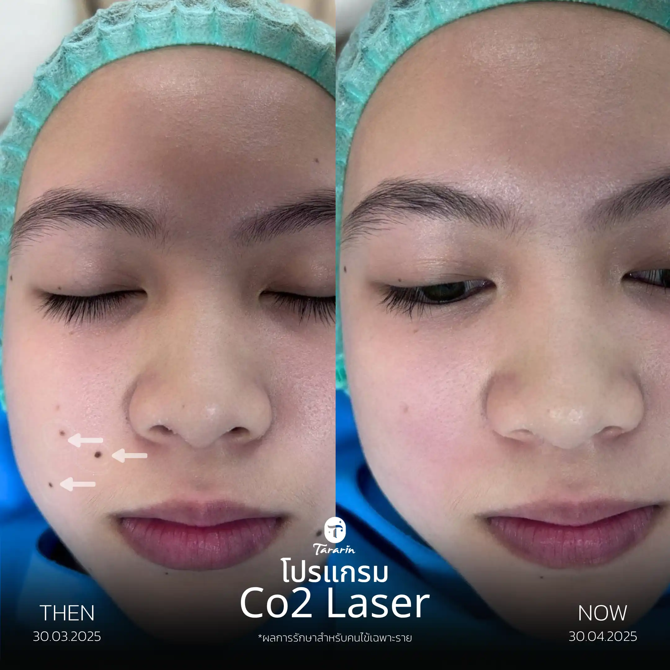 รีวิวโปรแกรมกำจัดไฝ CO2 Laser